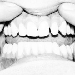 Imagem da notícia: Keep 32: Dentes à prova de cáries