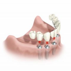 Imagem da notícia: Implantes dent&aacute;rios nem sempre s&atilde;o op&ccedil;&atilde;o acertada