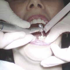 Imagem da notícia: Pe&ccedil;as interm&eacute;dias coincidentes podem n&atilde;o ser a melhor solu&ccedil;&atilde;o