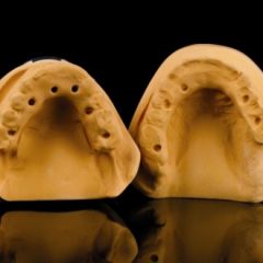 Imagem da notícia: Reabilita&ccedil;&atilde;o bimaxilar  em Prettau &reg;  aparafusada oclusalmente sobre bases de tit&acirc;nio