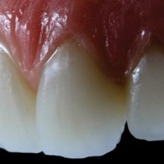 Imagem da notícia: Curso de Estética Funcional para técnicos de prótese dentária