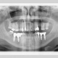 Imagem da notícia: Reabilita&ccedil;&atilde;o Est&eacute;tica com diferentes tipos de restaura&ccedil;&otilde;es fixas