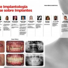 Imagem da notícia: Curso une Implantologia &agrave; Pr&oacute;tese Dent&aacute;ria