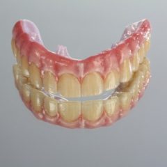 Imagem da notícia: Um trabalho completo para paciente exigente: reabilita&ccedil;&atilde;o superior sobre implantes em zirc&oacute;nio maci&ccedil;o (sem cer&acirc;mica)