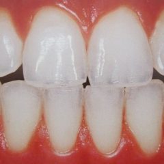 Imagem da notícia: Descoberto potencial tratamento duradouro para sensibilidade dent&aacute;ria