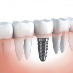 Imagem da notícia: Implantes dent&aacute;rios valorizam