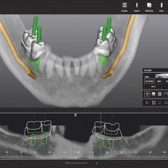 Imagem da notícia: Colaboração segura na inserção de implantes