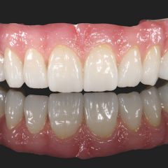 Imagem da notícia: Prettau® Anterior® Multistratum® –  a zirconia pré-colorida da Zirkonzahn