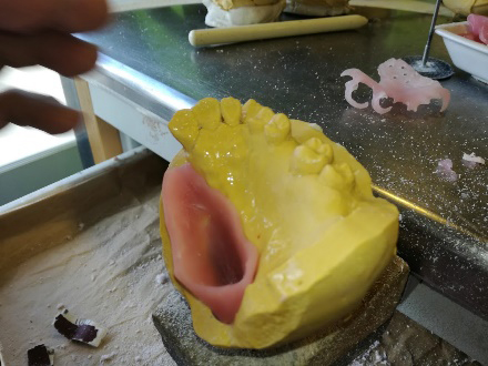 Imagem da notícia: Obturador maxilar em Poliamida flexível