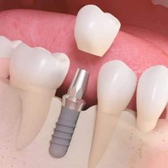 Imagem da notícia: Debate: Importância dos ossos nos implantes dentários