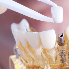 Imagem da notícia: Curso: Técnicas e aplicações para casos de implantes dentários