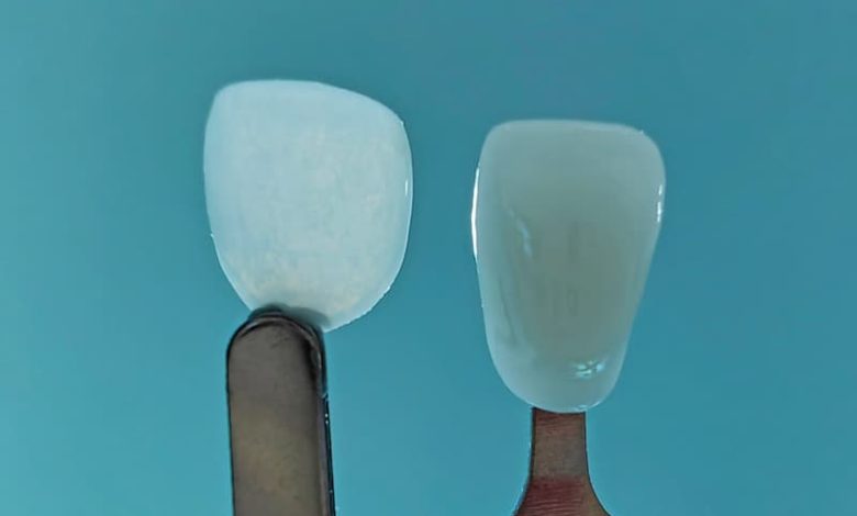 Imagem da notícia: UltraThineer, a faceta dentária cosmética mais fina do mundo