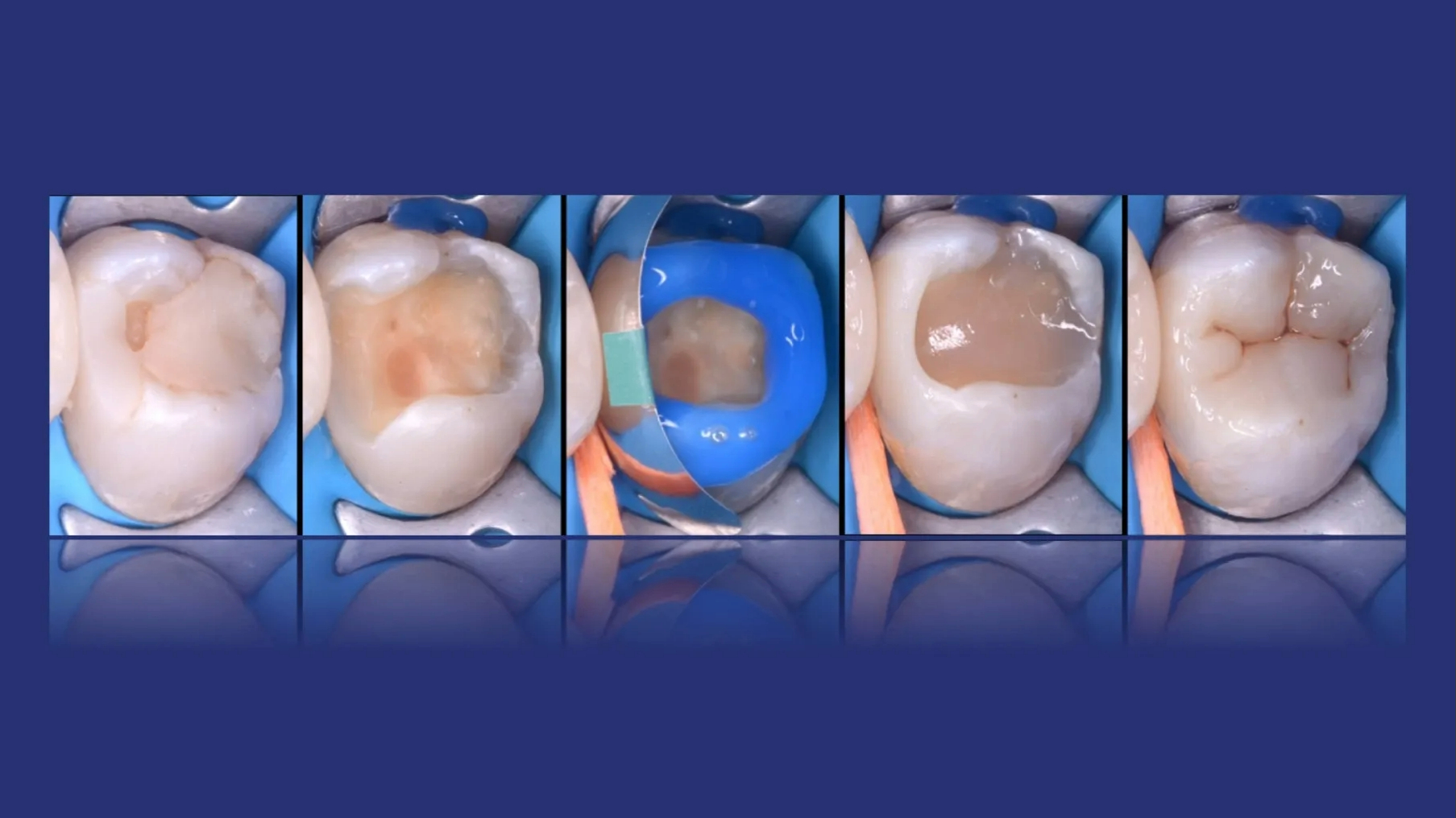 Imagem da notícia: Os fluxos de trabalho digitais nas reabilitações em zircónia