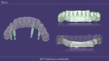 Imagem da notícia: Nova fronteira da medicina dentária: próteses fixas suportadas por implantes sem parafusos